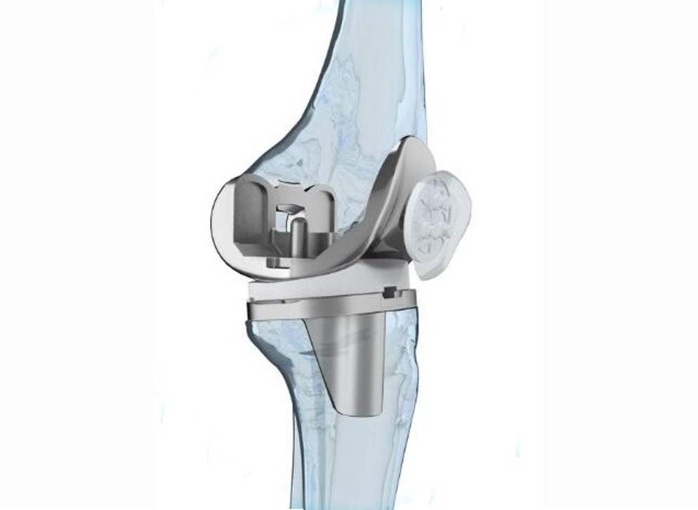 膝关节置换术的器械_全膝置换术前讨论记录_关节置换 质控小组